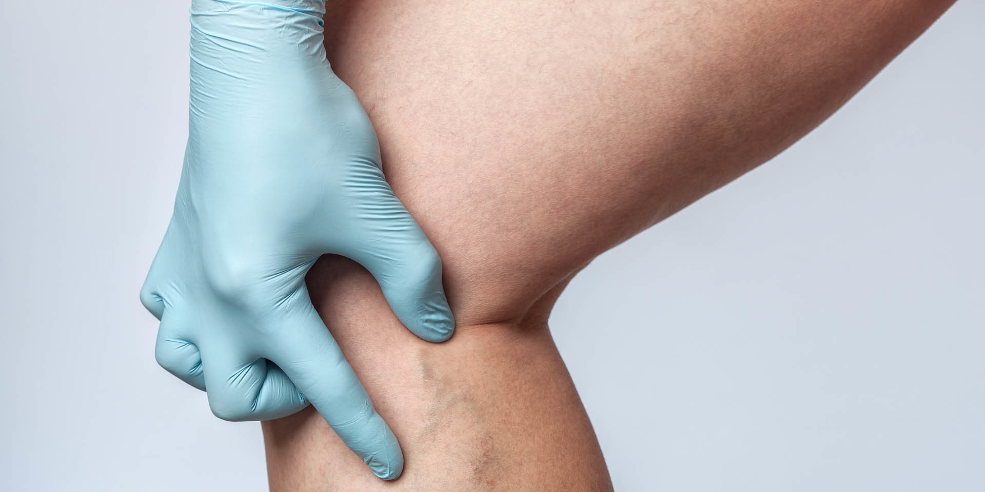 Sclerotherapy Training for Nurses & Doctors
