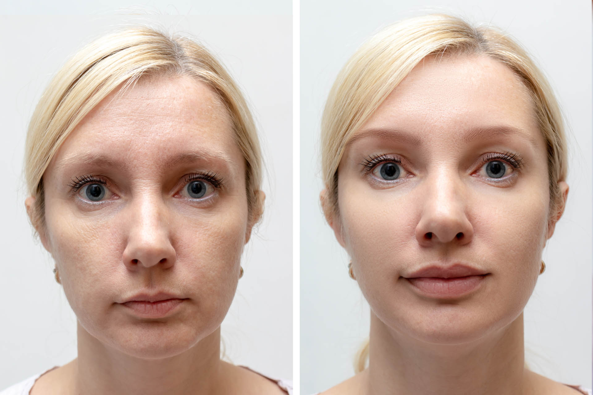 Before and After Advanced Botox and Dermal Filler Training